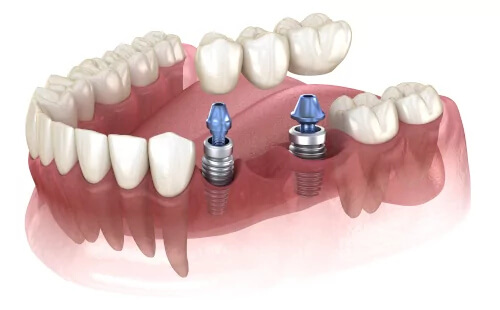 Bridges Implants