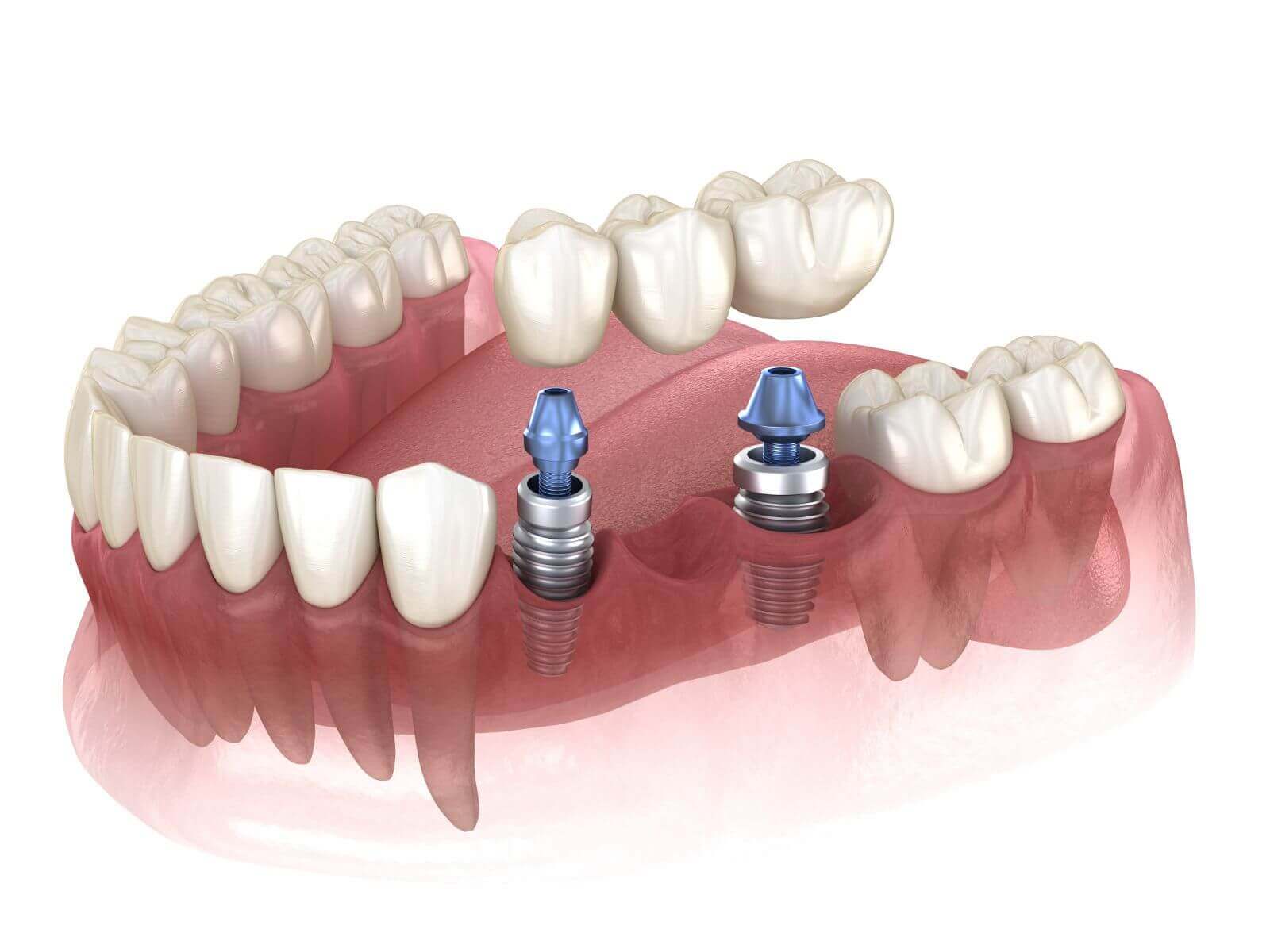 Dental Implants in Germany