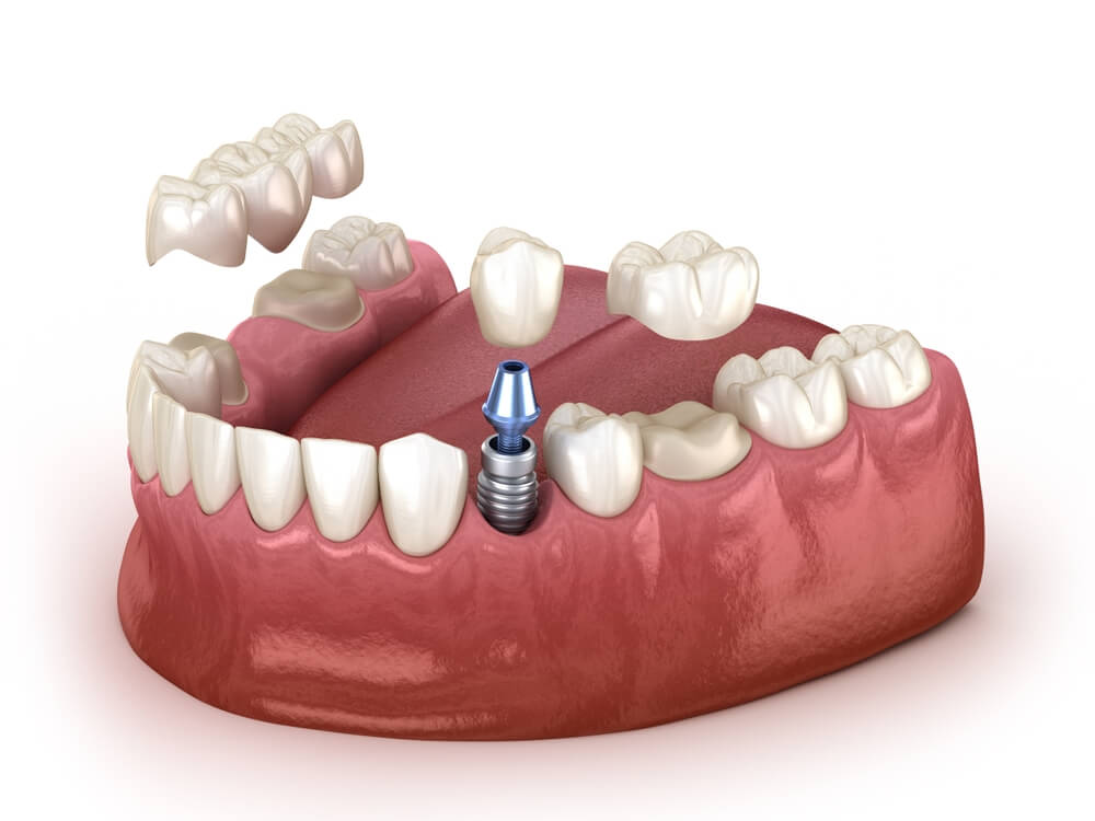 Tooth,Recovery,With,Implant,Crown,And,Bridge.,Medically,Accurate,3d